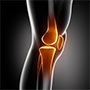 Knee Arthritis