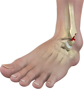 Ankle Fracture Treatment Twinsburg  Ankle Injury Treatment Chardon, Geauga  County