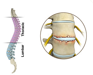 Fracture of the Thoracic and Lumbar Spine
