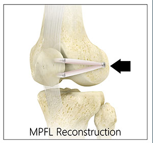 MPFL Reconstruction (Kneecap Stabilization)