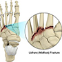 Lisfranc (Midfoot) Fracture
